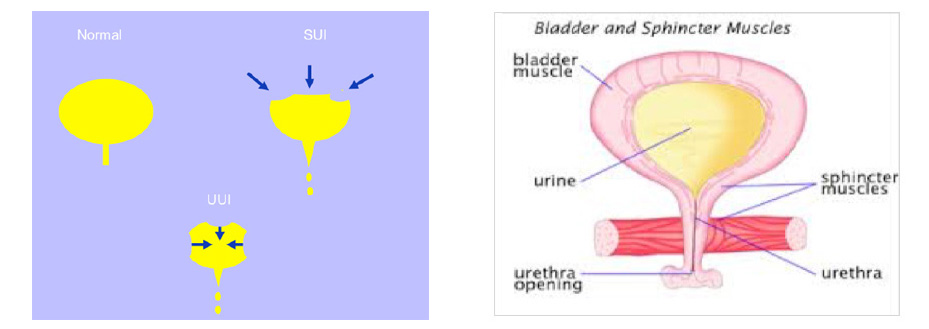 Urinary Incontinence in Women - Causes and Treatment of UI